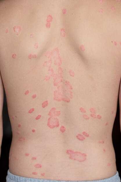 Симптомы герпеса на теле