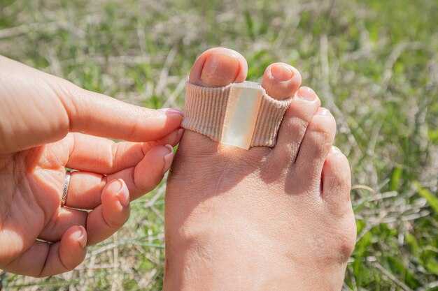 Симптомы перелома пальца на ноге