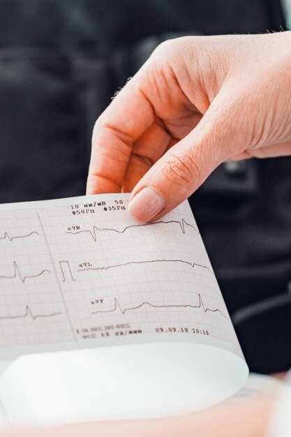 Как распознать основные виды аритмий на ЭКГ