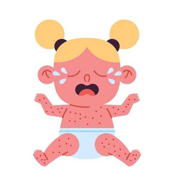 Как облегчить состояние ребенка с коревой сыпью